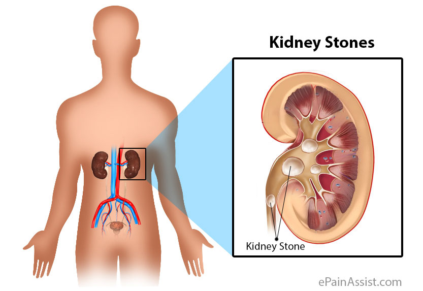 sexthreefourtimesaweekcanclearkidneystones